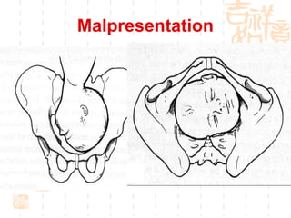 Malpresentation 
