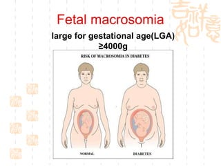 Fetal macrosomia large for gestational age(LGA) ≥4000g 