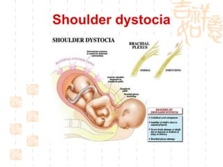 Shoulder dystocia 