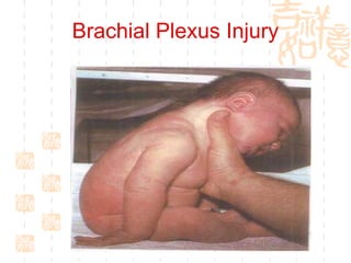 Brachial Plexus Injury 