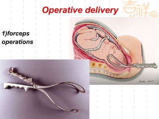 Operative delivery 1)forceps  operations 