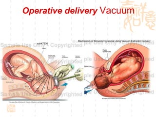 Operative delivery  Vacuum 