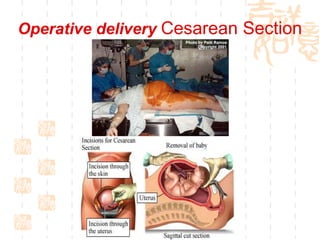 Operative delivery  Cesarean Section 