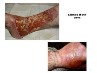 34
Example of skin
burns
 