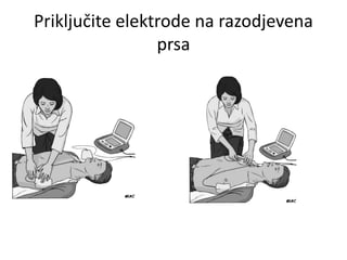 Priključite elektrode na razodjevena
prsa
 
