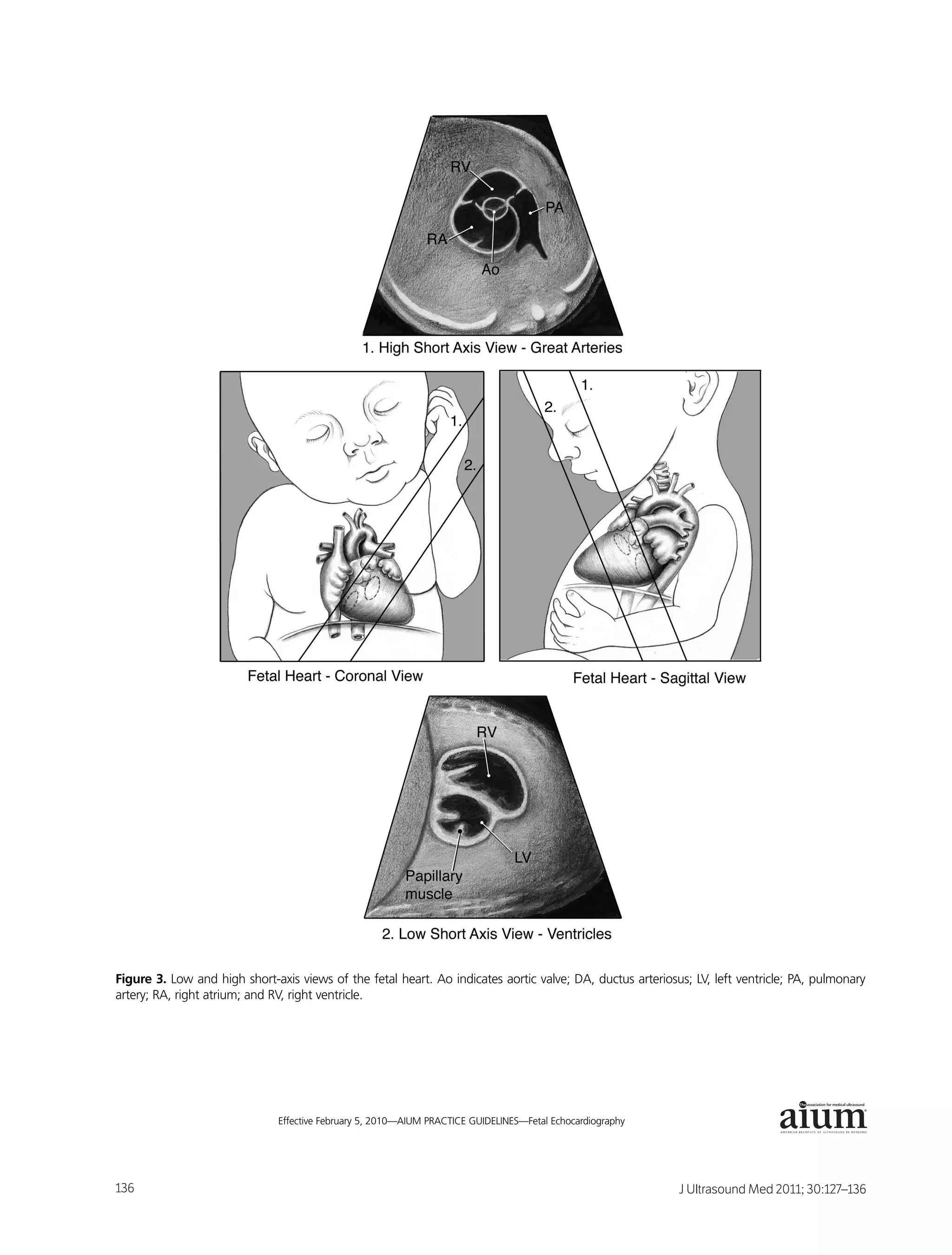 Figure 3. Low and high short-axis views of the fetal heart. Ao indicates aortic valve; DA, ductus arteriosus; LV, left ventricle; PA, pulmonary
artery; RA, right atrium; and RV, right ventricle.




                                                                                                                                              ®



8                              Effective February 5, 2010—AIUM PRACTICE GUIDELINES—Fetal Echocardiography




136                                                                                                         J Ultrasound Med 2011; 30:127–136
 