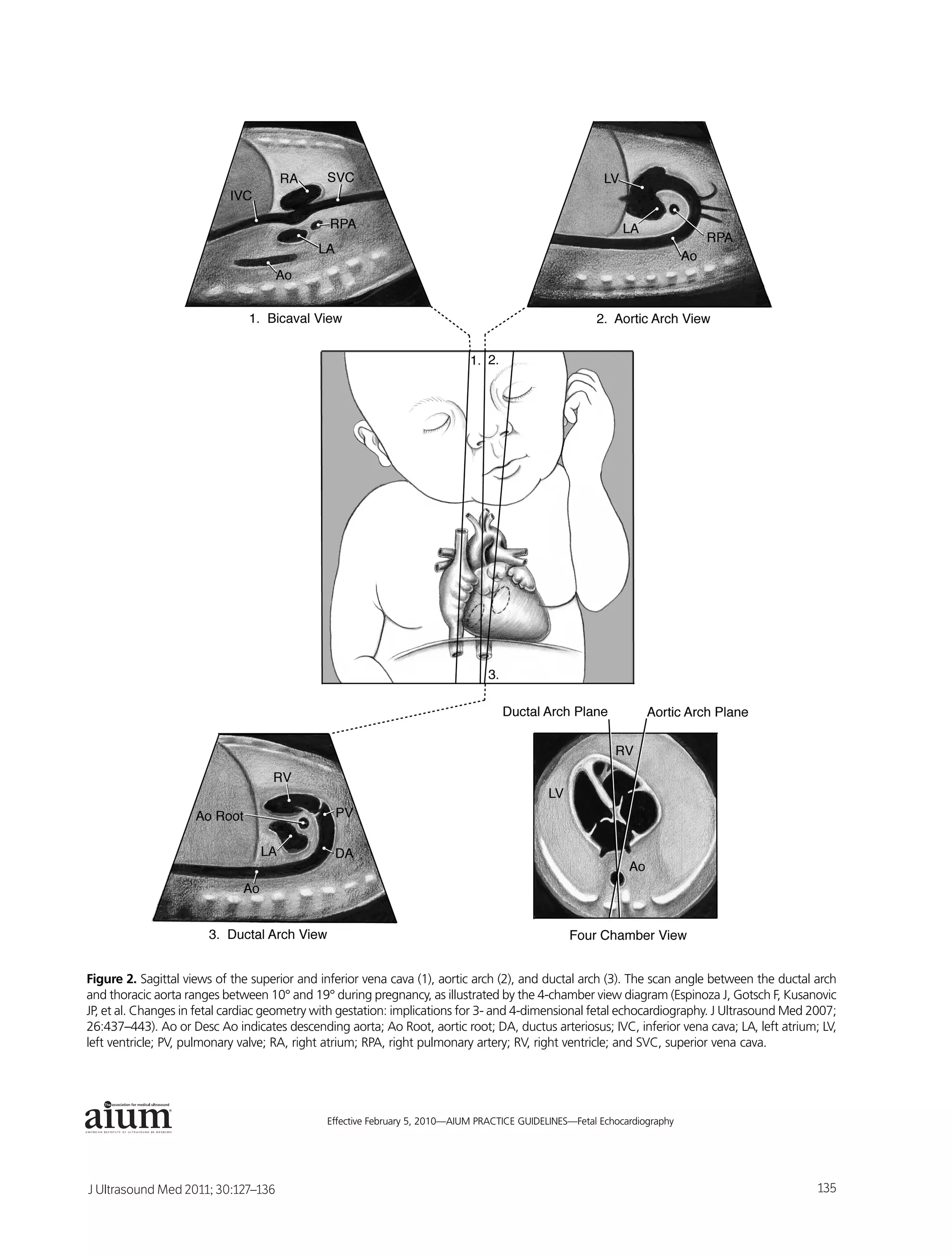 Figure 2. Sagittal views of the superior and inferior vena cava (1), aortic arch (2), and ductal arch (3). The scan angle between the ductal arch
and thoracic aorta ranges between 10° and 19° during pregnancy, as illustrated by the 4-chamber view diagram (Espinoza J, Gotsch F, Kusanovic
JP, et al. Changes in fetal cardiac geometry with gestation: implications for 3- and 4-dimensional fetal echocardiography. J Ultrasound Med 2007;
26:437–443). Ao or Desc Ao indicates descending aorta; Ao Root, aortic root; DA, ductus arteriosus; IVC, inferior vena cava; LA, left atrium; LV,
left ventricle; PV, pulmonary valve; RA, right atrium; RPA, right pulmonary artery; RV, right ventricle; and SVC, superior vena cava.




               ®



                                              Effective February 5, 2010—AIUM PRACTICE GUIDELINES—Fetal Echocardiography                       7




J Ultrasound Med 2011; 30:127–136                                                                                                            135
 