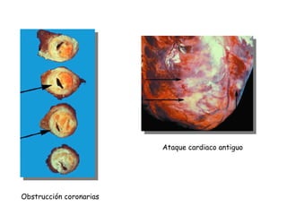 Ataque cardiaco antiguo Obstrucción coronarias 