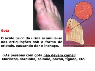 PRINCIPAIS DISTÚRBIO SIST URINÁRIO HUMANOPedra nos rinsDepósito de minerais (cálcio, etc) nos rins, porque os rins não os conseguem eliminarPodem descer e acumular-se nos ureteres, na bexiga e na uretra.