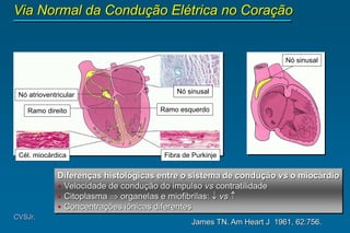 James TN. Am Heart J 1961, 62:756.
CVSJr.
Via Normal da Condução Elétrica no Coração
Nó sinusal
Nó atrioventricular
Ramo esquerdo
Ramo direito
Cél. miocárdica Fibra de Purkinje
Nó sinusal
Diferenças histológicas entre o sistema de condução vs o miocárdio
• Velocidade de condução do impulso vs contratilidade
• Citoplasma  organelas e miofibrilas:  vs 
• Concentrações iônicas diferentes
 