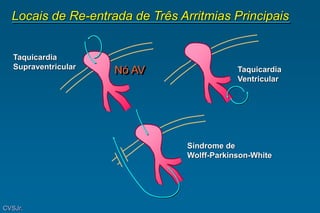 Locais de Re-entrada de Três Arritmias Principais
Taquicardia
Supraventricular Taquicardia
Ventricular
Síndrome de
Wolff-Parkinson-White
CVSJr.
Nó AV
 