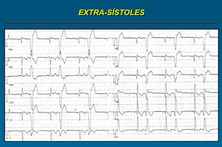 EXTRA-SÍSTOLES
 