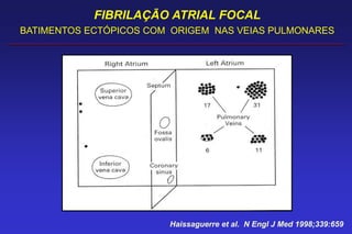 FIBRILAÇÃO ATRIAL FOCAL
BATIMENTOS ECTÓPICOS COM ORIGEM NAS VEIAS PULMONARES
Haissaguerre et al. N Engl J Med 1998;339:659
 