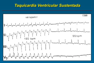 Taquicardia Ventricular Sustentada
 