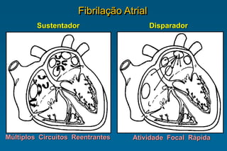 Múltiplos Circuitos Reentrantes Atividade Focal Rápida
Disparador
Sustentador
Fibrilação Atrial
 