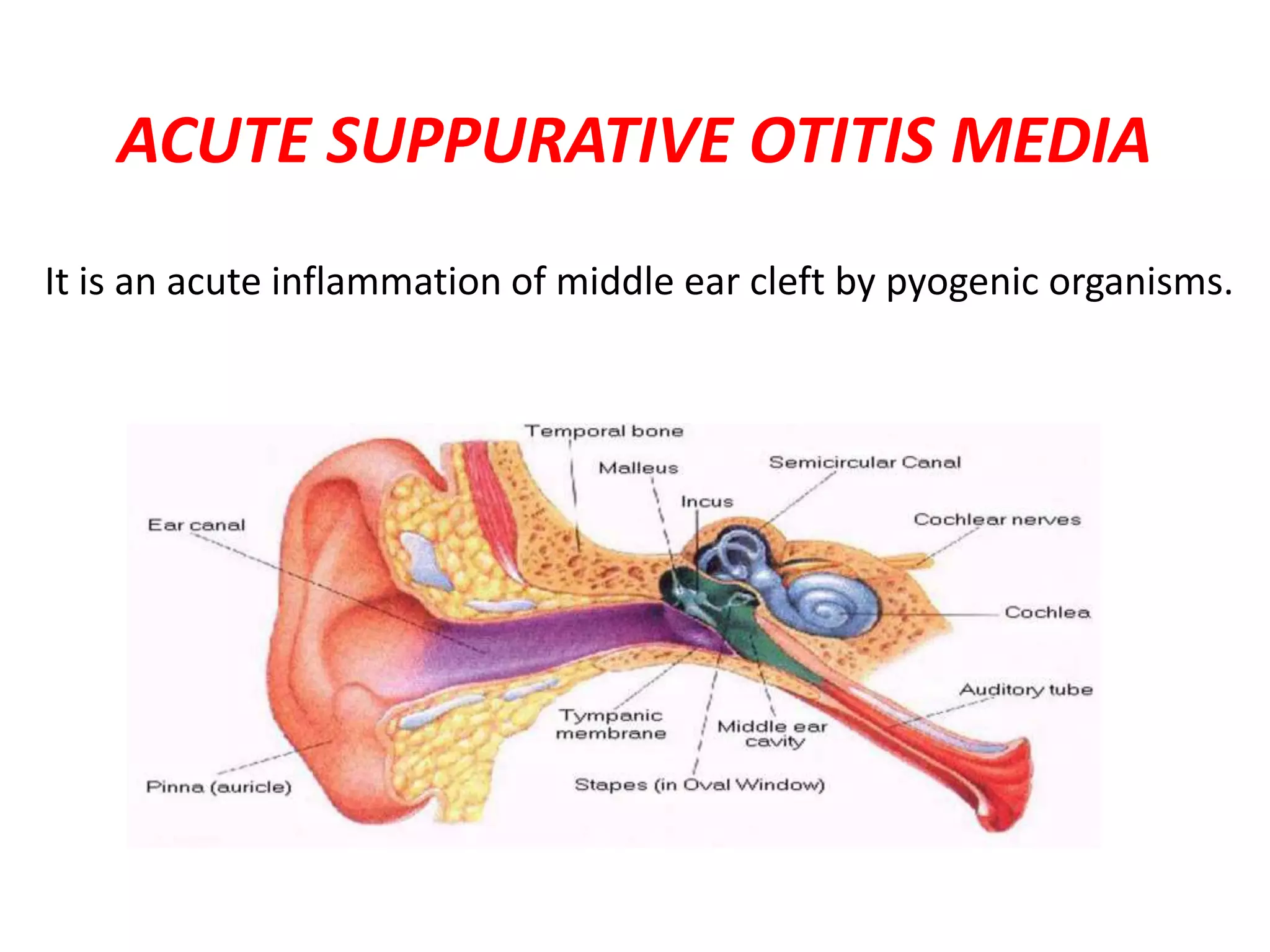 ACUTE SUPPURATIVE OTITIS MEDIA | PPTX