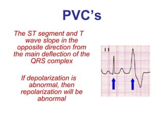 PVC’s The ST segment and T wave slope in the opposite direction from the main deflection of the QRS complex If depolarization is abnormal, then repolarization will be abnormal 