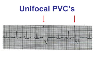 Unifocal PVC’s 