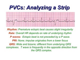 PVCs: Analyzing a Strip  Rhythm:   Premature ectopic beat causes slight irregularity Rate:  Overall HR depends on rate of underlying rhythm P waves:  Ectopic beat is not preceded by a P wave. PRI:  None; impulse originates from a lower focus QRS:  Wide and bizarre; different from underlying QRS complexes.  T wave is frequently in the opposite direction from the QRS complex. 