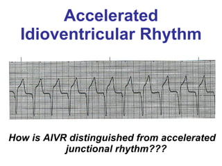 Accelerated Idioventricular Rhythm How is AIVR distinguished from accelerated junctional rhythm??? 