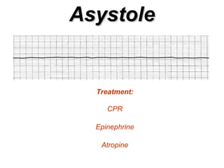 Asystole Treatment: CPR Epinephrine Atropine 