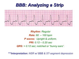 BBB: Analyzing a Strip Rhythm:   Regular Rate:  60  – 100 bpm P waves:  Upright & uniform. PRI:  0.12 – 0.20 sec QRS:  > 0.12 sec; notched or “bunny ears”. ***Interpretation:  NSR w/ BBB & ST-segment depression 