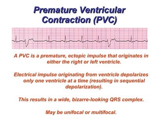 Premature Ventricular Contraction (PVC) A PVC is a premature, ectopic impulse that originates in either the right or left ventricle. Electrical impulse originating from ventricle depolarizes only one ventricle at a time (resulting in sequential depolarization). This results in a wide, bizarre-looking QRS complex. May be unifocal or multifocal. 