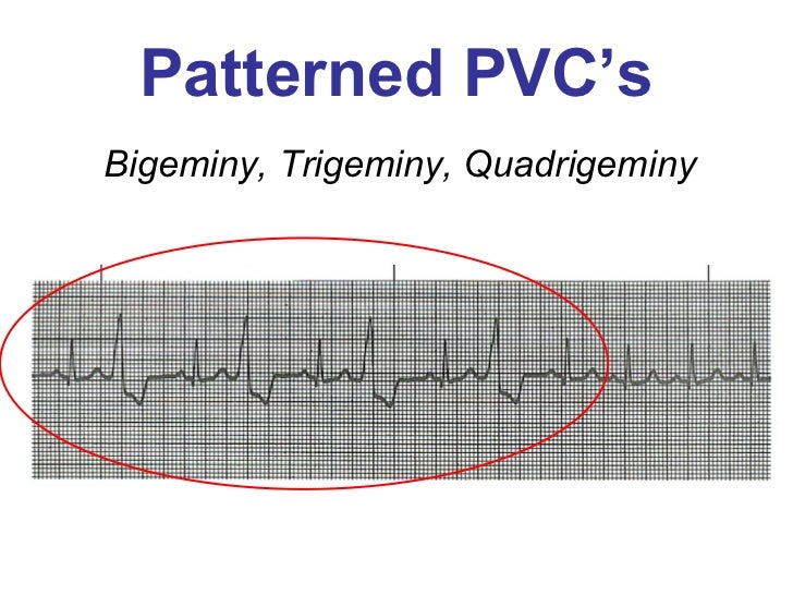 Ventricular Rhythms BMH/Tele