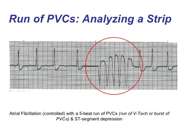 Ventricular Rhythms BMH/Tele