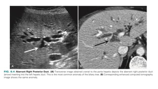 Comprehensive Imaging and RADIOLOGY of the Biliary Tract | PPTX