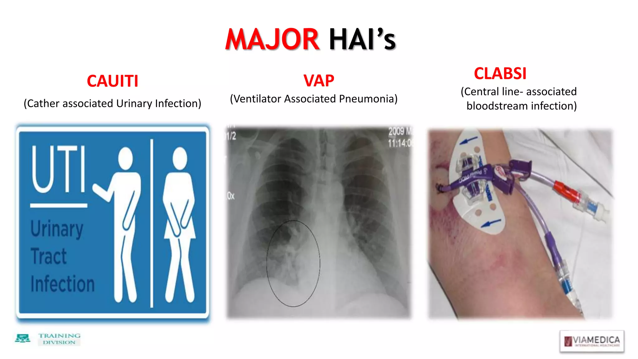 MAJOR HAI’s
CAUITI
(Cather associated Urinary Infection)
VAP
(Ventilator Associated Pneumonia)
CLABSI
(Central line- associated
bloodstream infection)
 