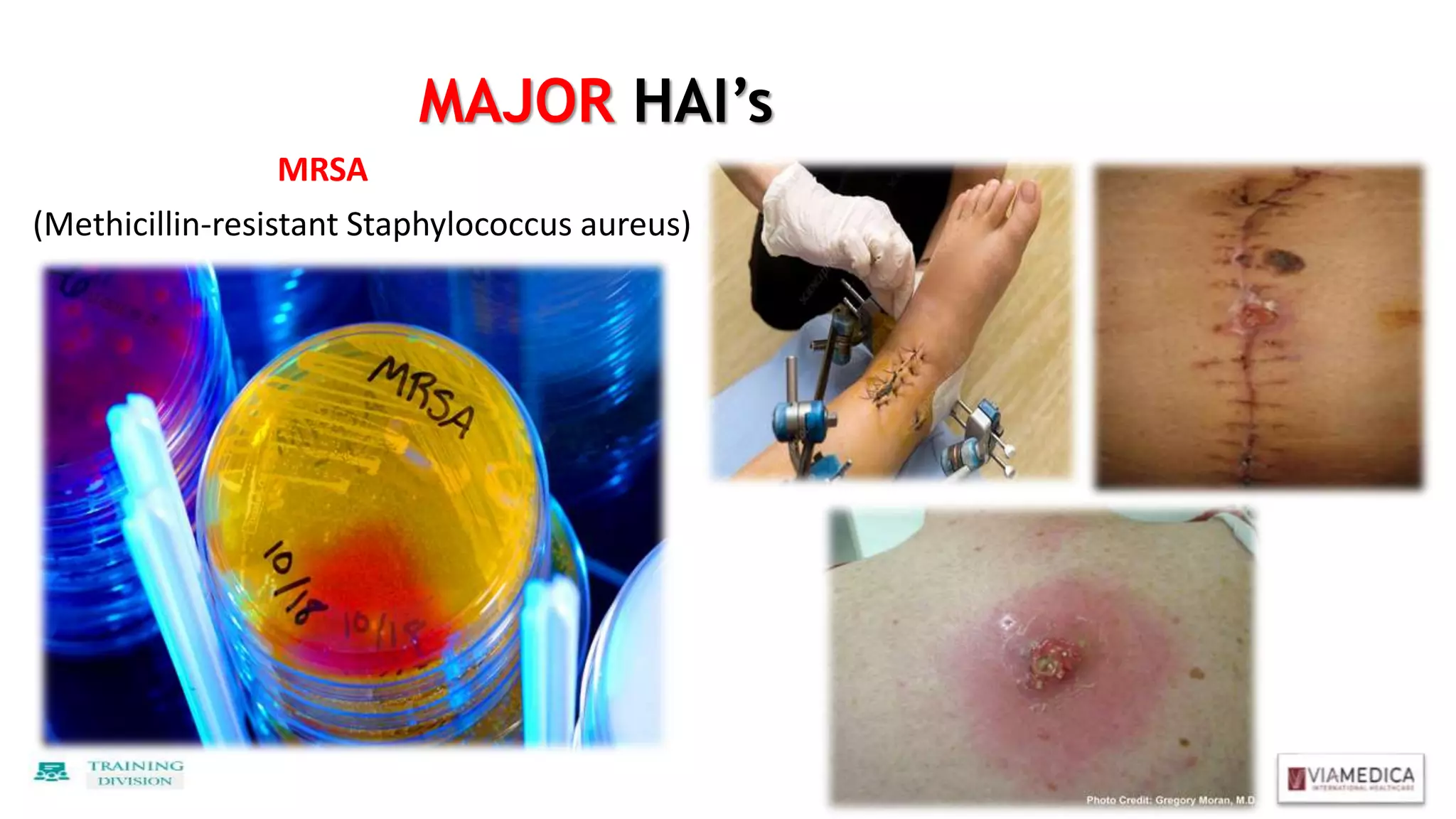 MAJOR HAI’s
MRSA
(Methicillin-resistant Staphylococcus aureus)
 