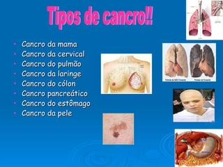 Cancro da mama Cancro da cervical Cancro do pulmão Cancro da laringe Cancro do cólon Cancro pancreático Cancro do estômago Cancro da pele Tipos de cancro!! 