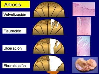 Artrosis Velvetización Fisuración Ulceración Eburnización 