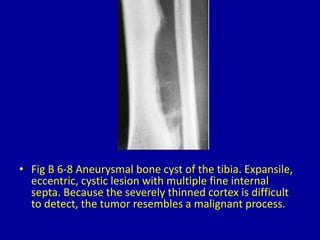 6 bubbly lesions of bone | PPTX