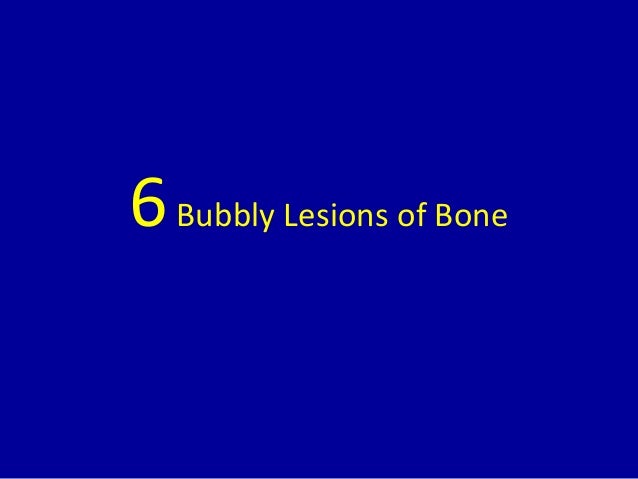 6 bubbly lesions of bone 1 638 jpg cb 1437284160 bubbly images