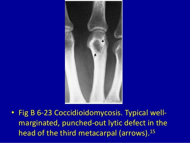 6 bubbly lesions of bone