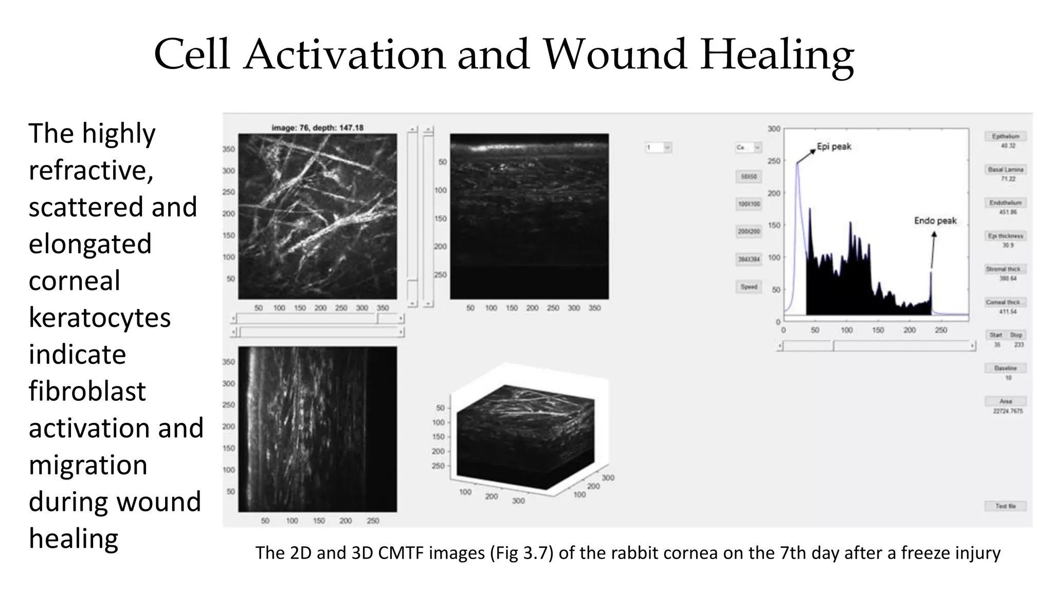 Cell Activation and Wound Healing
The 2D and 3D CMTF images (Fig 3.7) of the rabbit cornea on the 7th day after a freeze injury
The highly
refractive,
scattered and
elongated
corneal
keratocytes
indicate
fibroblast
activation and
migration
during wound
healing
 