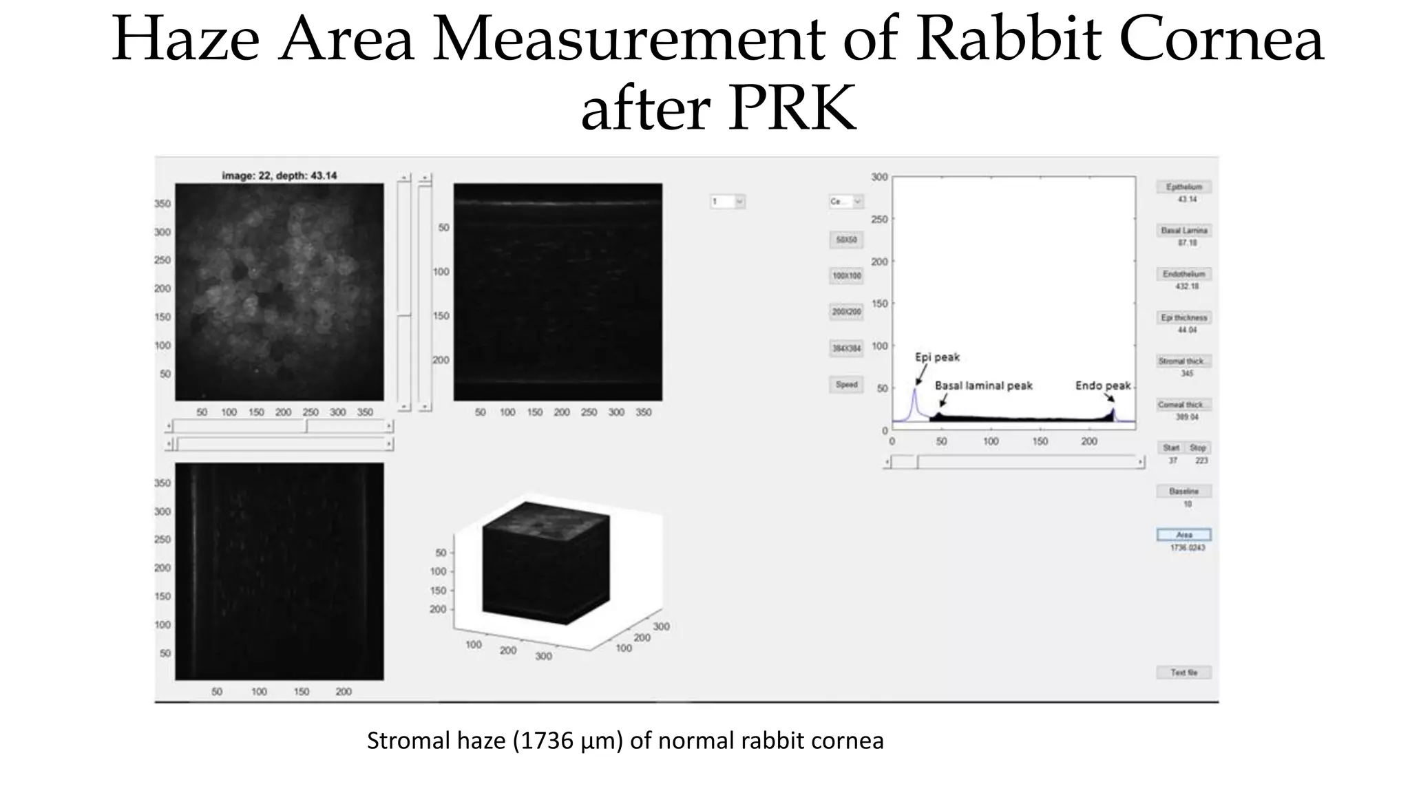 Haze Area Measurement of Rabbit Cornea
after PRK
Stromal haze (1736 µm) of normal rabbit cornea
 