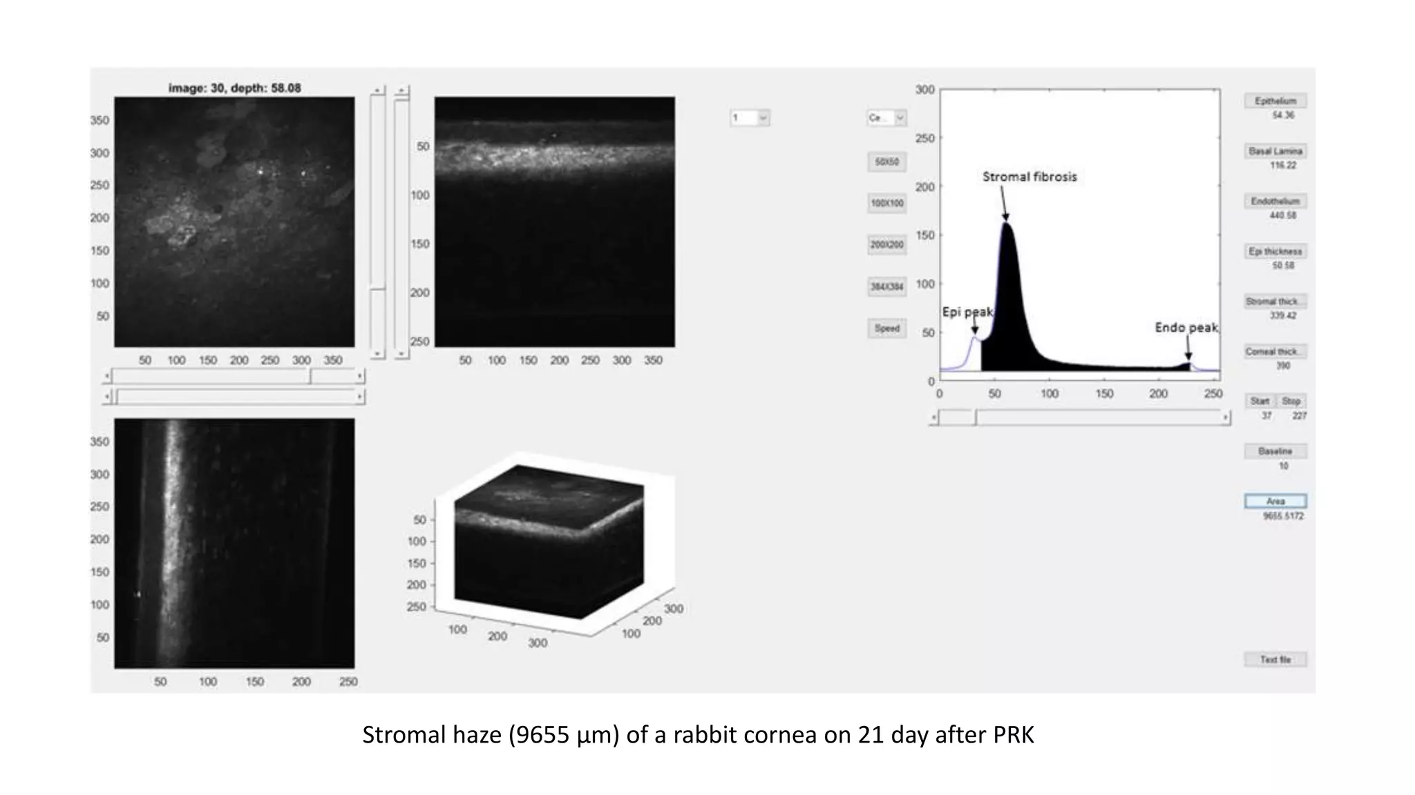 Stromal haze (9655 µm) of a rabbit cornea on 21 day after PRK
 