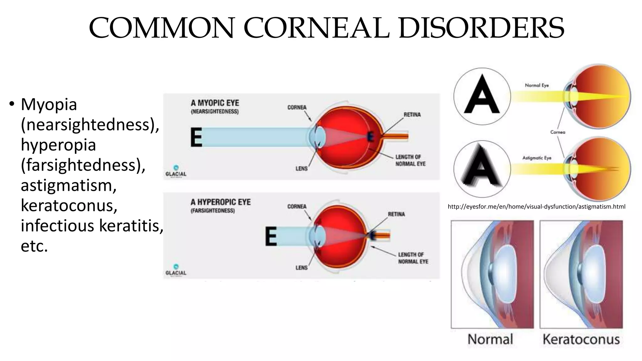 COMMON CORNEAL DISORDERS
• Myopia
(nearsightedness),
hyperopia
(farsightedness),
astigmatism,
keratoconus,
infectious keratitis,
etc.
http://eyesfor.me/en/home/visual-dysfunction/astigmatism.html
 