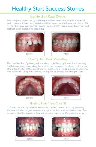 Healthy Start Case: Overjet
The overjet is corrected by allowing the lower jaw to develop in a forward
and downward direction. With the advancement of the lower jaw, the profile
of the child improves and the airway is enlarged to create nasal breathing and
address sleep disordered breathing.
Before After
Before After
AfterBefore
Healthy Start Case: Crowding
The Healthy Start System guides and corrects the eruption of the incoming
teeth by naturally expanding the arch to provide room for these teeth, or can
straighten the teeth that are already present, and develop proper swallowing.
This allows for proper breathing, an expanded airway, and straight teeth.
Healthy Start Case: Class III
The Healthy Start System addresses and corrects the Class III by allowing
the force of the tongue to move the upper arch in a forward direction. The
movement of the jaws in a forward direction opens up the patient’s airway.
Healthy Start Success Stories
 