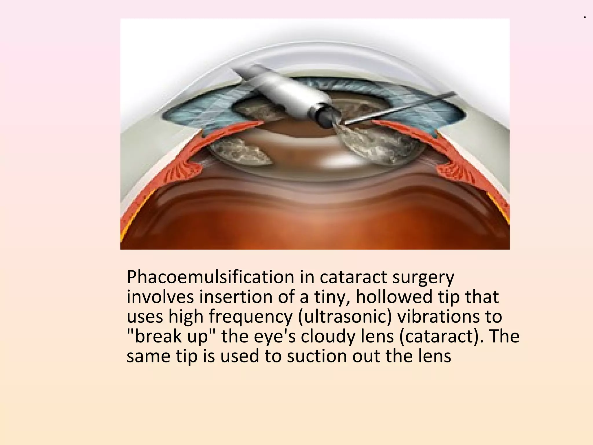 Phacoemulsification in cataract surgery
involves insertion of a tiny, hollowed tip that
uses high frequency (ultrasonic) vibrations to
"break up" the eye's cloudy lens (cataract). The
same tip is used to suction out the lens
.
 