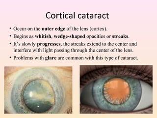 Cortical cataract
• Occur on the outer edge of the lens (cortex).
• Begins as whitish, wedge-shaped opacities or streaks.
• It’s slowly progresses, the streaks extend to the center and
interfere with light passing through the center of the lens.
• Problems with glare are common with this type of cataract.
 