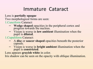 Immature Cataract
Lens is partially opaque
Two morphological forms are seen:
1.Cuneiform Cataract:
– Wedge shaped opacities in the peripheral cortex and
progress towards the nucleus.
– Vision is worse in low ambient illumination when the
pupil is dilated.
1.Cupuliform Cataract:
– A disc or saucer shaped opacities beneath the posterior
capsule.
– Vision is worse in bright ambient illumination when the
pupil is constricted.
Lens appears grayish white in color.
Iris shadow can be seen on the opacity with oblique illumination.
 