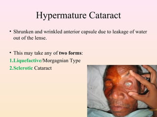 Hypermature Cataract
• Shrunken and wrinkled anterior capsule due to leakage of water
out of the lense.
• This may take any of two forms:
1.Liquefactive/Morgagnian Type
2.Sclerotic Cataract
 