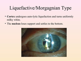 Liquefactive/Morgagnian Type
• Cortex undergoes auto-lytic liquefaction and turns uniformly
milky white.
• The nucleus loses support and settles to the bottom.
 