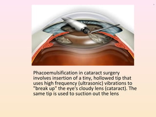 Phacoemulsification in cataract surgery
involves insertion of a tiny, hollowed tip that
uses high frequency (ultrasonic) vibrations to
"break up" the eye's cloudy lens (cataract). The
same tip is used to suction out the lens
.
 