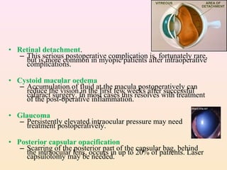 • Retinal detachment.
– This serious postoperative complication is, fortunately rare,
but is more common in myopic patients after intraoperative
complications.
• Cystoid macular oedema
– Accumulation of fluid at the macula postoperatively can
reduce the vision in the first few weeks after successful
cataract surgery. In most cases this resolves with treatment
of the post-operative inflammation.
• Glaucoma
– Persistently elevated intraocular pressure may need
treatment postoperatively.
• Posterior capsular opacification
– Scarring of the posterior part of the capsular bag, behind
the intraocular lens, occurs in up to 20% of patients. Laser
capsulotomy may be needed.
 
