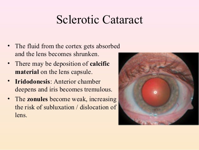 6 Cataract